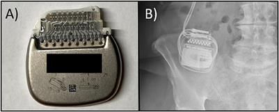 Hematoma-induced Twiddler-like phenomenon as a presentation of DBS hardware failure: Case report